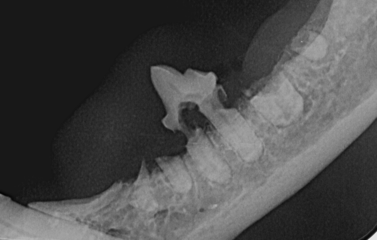 intraorální snímek levé dolní čelisti - odlomené korunky zubů se "zapomenutými" kořeny