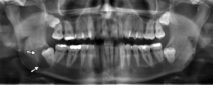 zubní cysta kolem zubu moudrosti u člověka