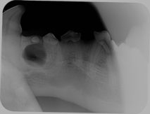 zubní cysta kolem zadrženého prvního premoláru